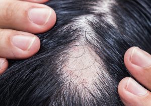 Female Hair Loss: Here’s What You Should Know!