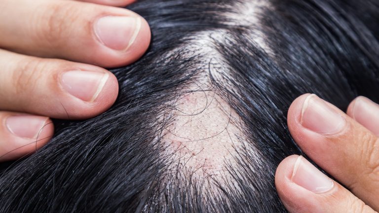 Female Hair Loss: Here’s What You Should Know!